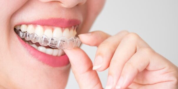 Descubre Los Tipos De Ortodoncia Que Existen Like Dental