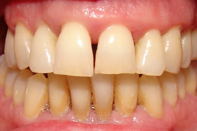 odontología general en Villanueva del Pardillo – espacios interdentales