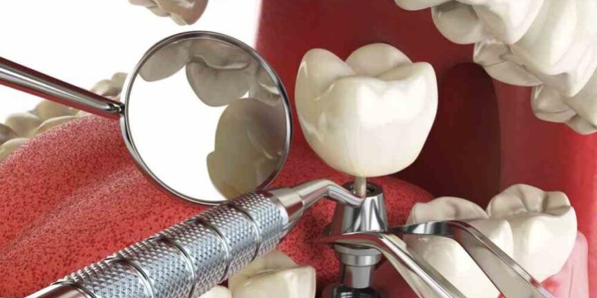 protesis dental - modelo 3d