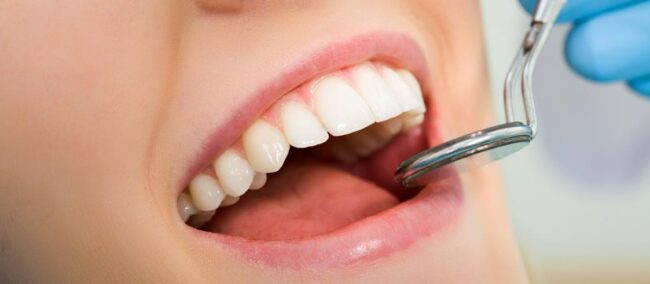 clinica dental cerca de Brunete - limpieza con espejo