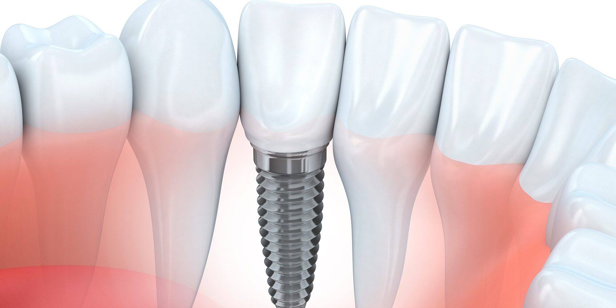 clinica dental cerca de Villanueva de la Cañada – protesis dental clinica dental cerca de Villanueva de la Cañada - protesis dental