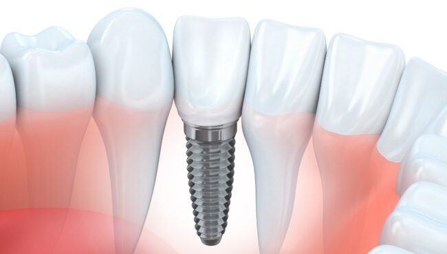 clinica dental cerca de Villanueva de la Cañada - protesis dental