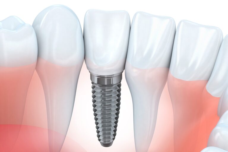 clinica dental cerca de Villanueva de la Cañada – protesis dental clinica dental cerca de Villanueva de la Cañada - protesis dental