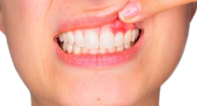 periodoncia en Villanueva del Pardillo - dientes inflamados