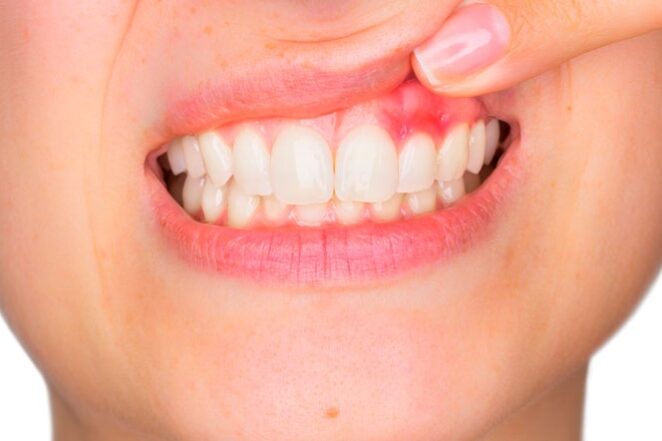 periodoncia en Villanueva del Pardillo – dientes inflamados periodoncia en Villanueva del Pardillo - dientes inflamados