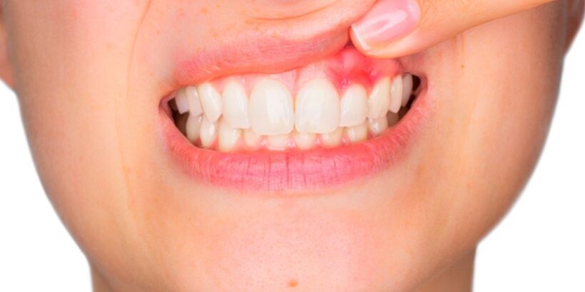 periodoncia en Villanueva del Pardillo – dientes inflamados periodoncia en Villanueva del Pardillo - dientes inflamados