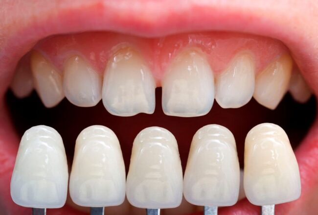 clinica dental cerca de Majadahonda - carillas de porcelana