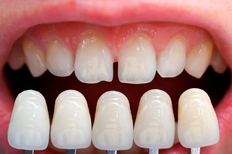 clinica dental cerca de Majadahonda – carillas de porcelana clinica dental cerca de Majadahonda - carillas de porcelana