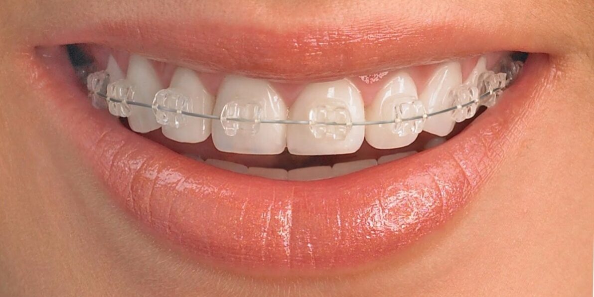 odontología estética en Villanueva del Pardillo – sonrisa con brackets de zafiro odontología estética en Villanueva del Pardillo - sonrisa con brackets de zafiro