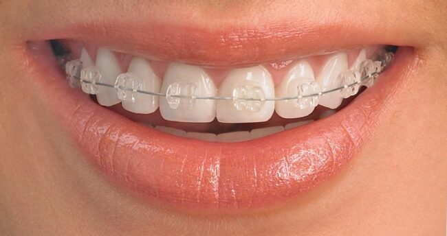 odontología estética en Villanueva del Pardillo - sonrisa con brackets de zafiro