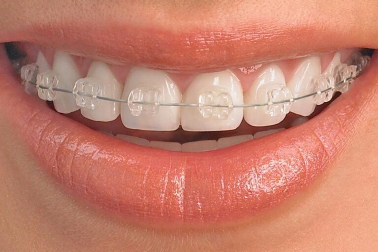 odontología estética en Villanueva del Pardillo – sonrisa con brackets de zafiro odontología estética en Villanueva del Pardillo - sonrisa con brackets de zafiro