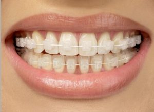 odontología estética en Villanueva del Pardillo - brackets de zafiro