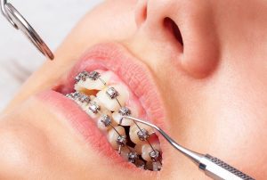 odontologia estetica en Majadahonda - ortodoncia de metal