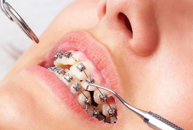 odontologia estetica en Majadahonda - ortodoncia de metal