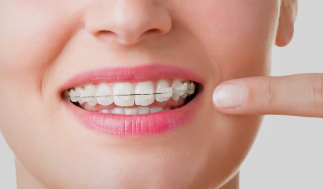 ortodoncia en Brunete - ortodoncia invisible