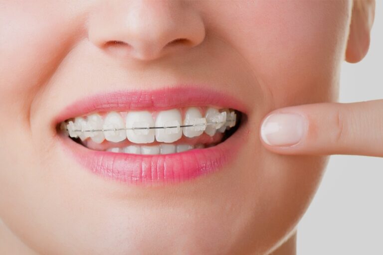 ortodoncia en Brunete – ortodoncia invisible ortodoncia en Brunete - ortodoncia invisible