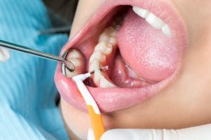 clinica dental cerca de Majadahonda - limpieza dental