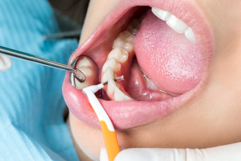 clinica dental cerca de Majadahonda – limpieza dental clinica dental cerca de Majadahonda - limpieza dental