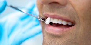 implantologia en Villanueva del Pardillo - coronas dentales