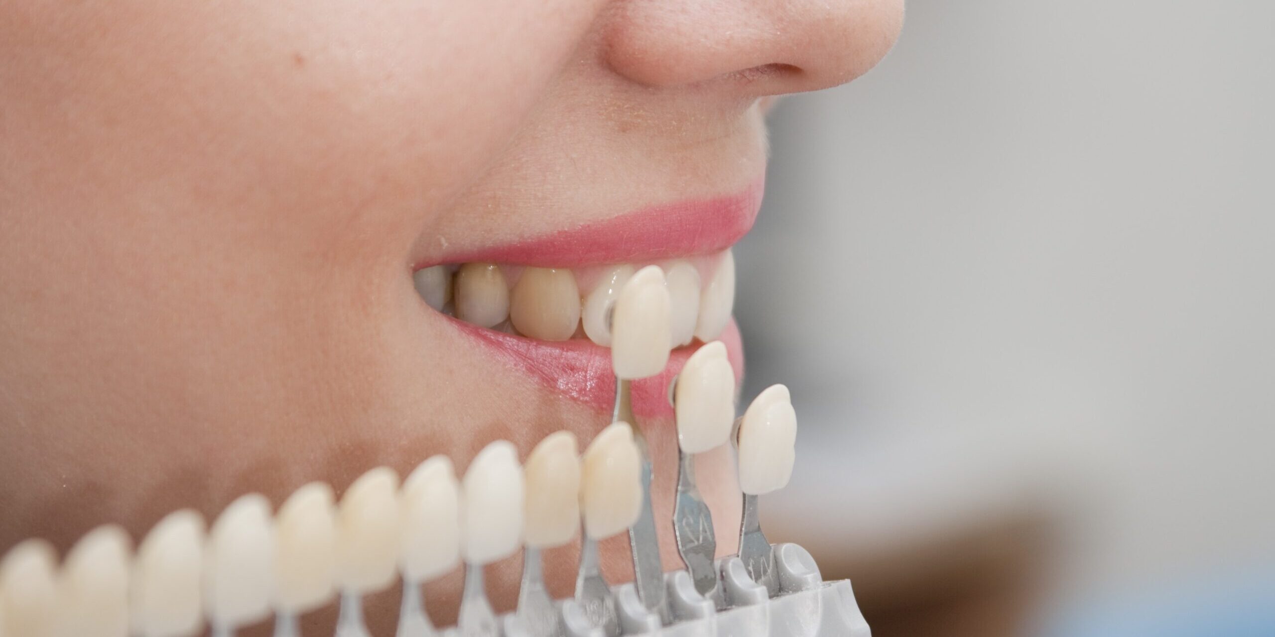 protesis dental en Majadahonda – estudio de dientes protesis dental en Majadahonda - estudio de dientes