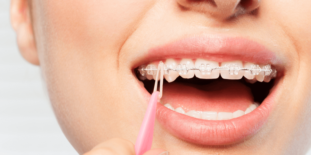 brackets cerámicos en Brunete – ortodoncia transparente brackets cerámicos en Brunete - ortodoncia transparente