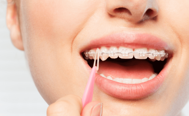 brackets cerámicos en Brunete - ortodoncia transparente