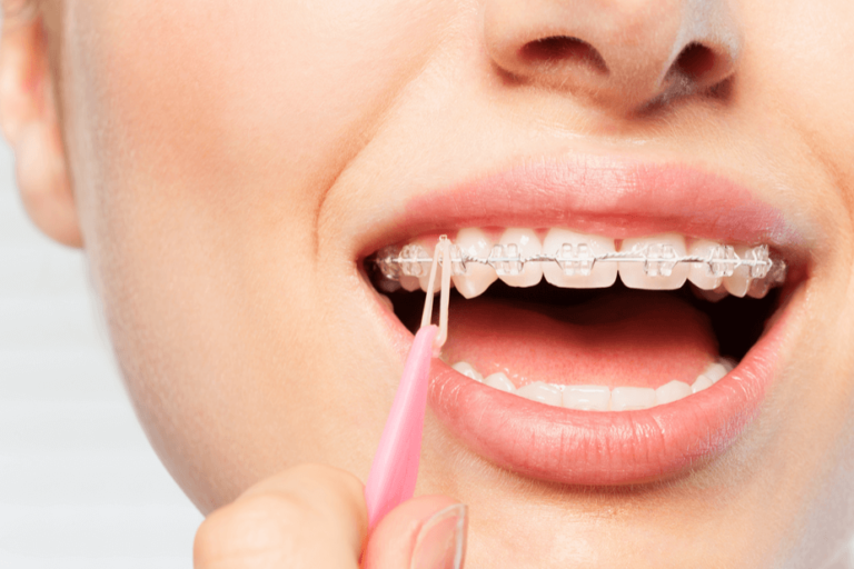 brackets cerámicos en Brunete – ortodoncia transparente brackets cerámicos en Brunete - ortodoncia transparente