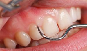 tratamiento de periodoncia cerca de Majadahonda - rascar dientes