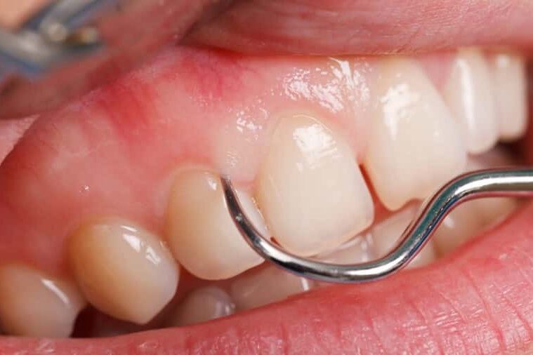 tratamiento de periodoncia cerca de Majadahonda – rascar dientes tratamiento de periodoncia cerca de Majadahonda - rascar dientes