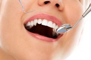 tratamiento de periodoncia cerca de Majadahonda - sonrisa blanca