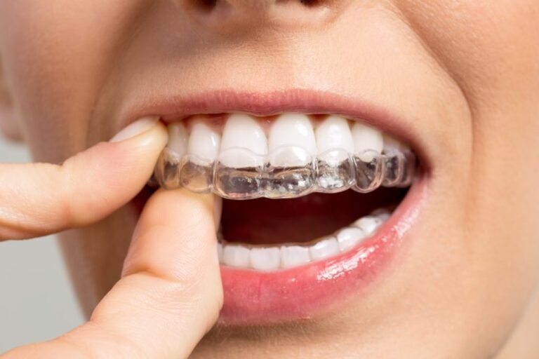 bruxismo – ferula de descarga bruxismo - ferula de descarga