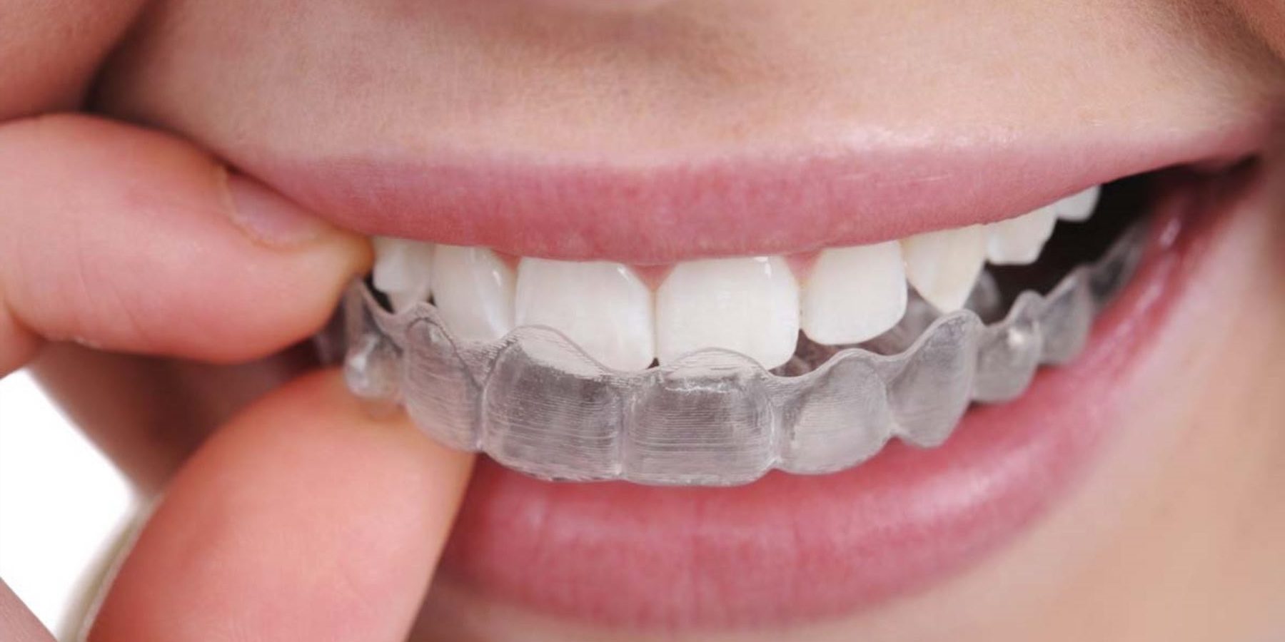 Férula de descarga para tratara el Bruxismo - Clínica Area Dental