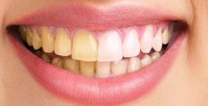 dientes amarillos - antes y después