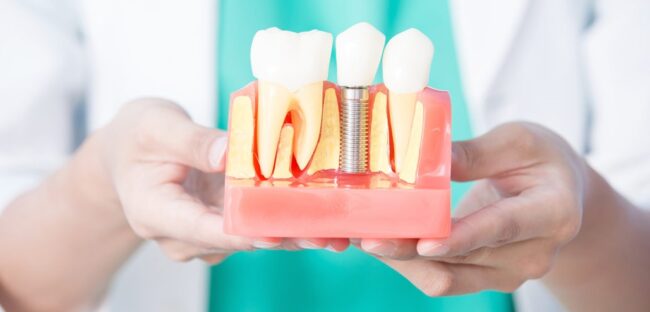 implantología y cirugía en Majadahonda - protesis