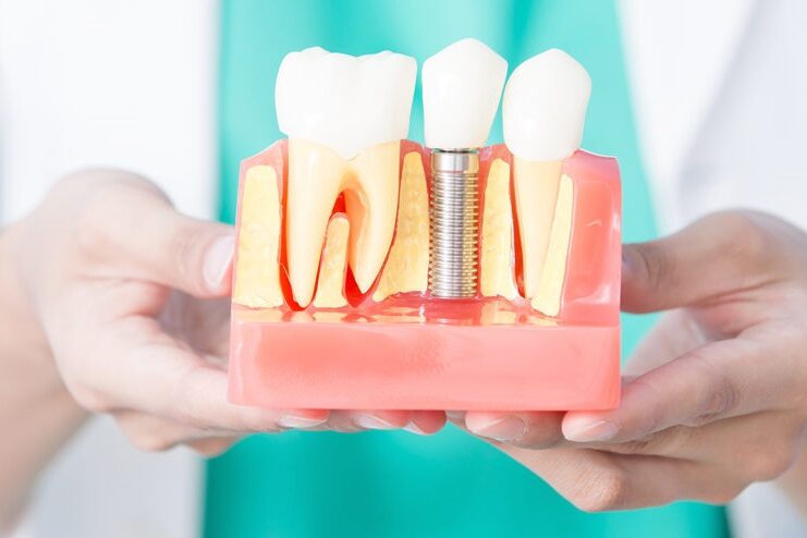 implantología y cirugía en Majadahonda – protesis implantología y cirugía en Majadahonda - protesis