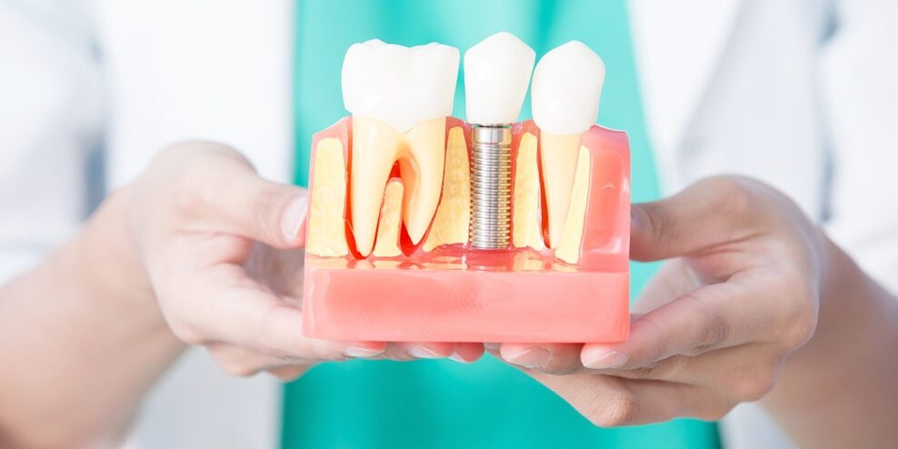 implantología y cirugía en Majadahonda - protesis