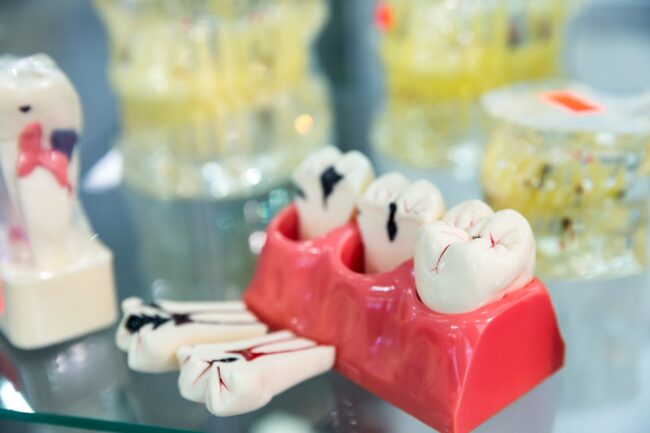 endodoncia en Brunete - diente con caries