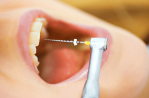 endodoncia en Brunete - herramientas