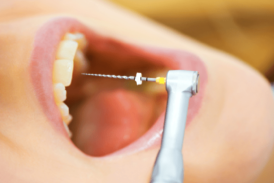 endodoncia en Brunete – herramientas endodoncia en Brunete - herramientas