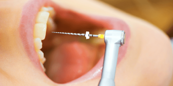 endodoncia en Brunete – herramientas endodoncia en Brunete - herramientas