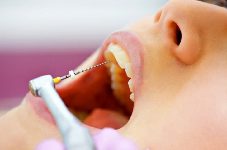¿cuándo Es Mejor Realizarse Un Tratamiento De Endodoncia Like Dentalemk 6965