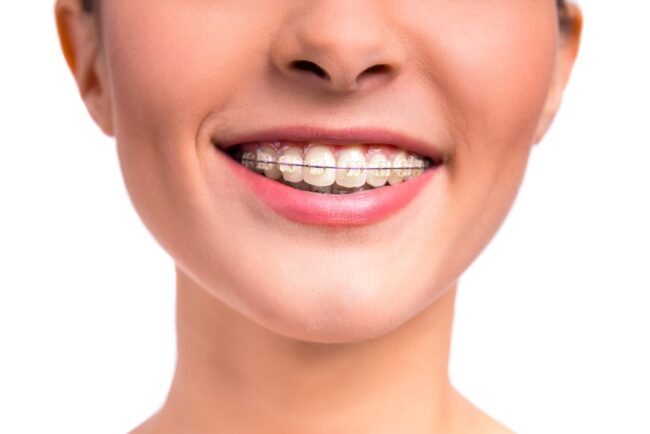 ortodoncia persona embarazada - ortodoncia