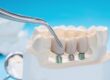 Prótesis dental en Majadahonda - Tornillos