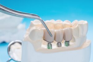 Prótesis dental en Majadahonda - Tornillos