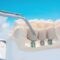 Prótesis dental en Majadahonda - Tornillos