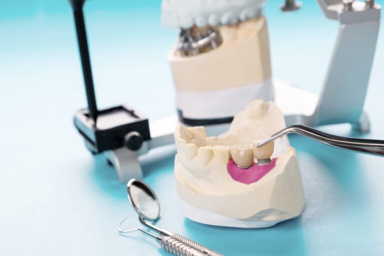 implantología y cirugía cerca de  Majadahonda – modelo de protesis implantología y cirugía cerca de Majadahonda - modelo de protesis