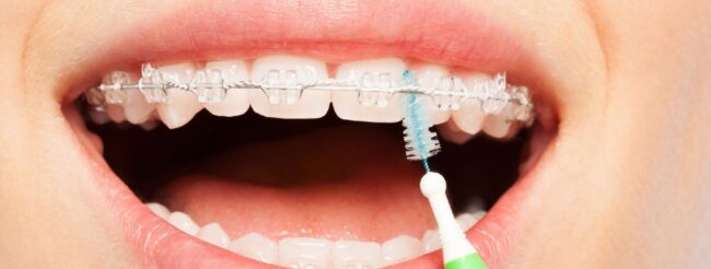 higiene con la ortodoncia