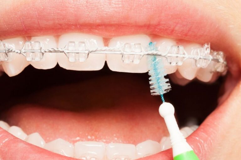 higiene con la ortodoncia – Impieza higiene con la ortodoncia