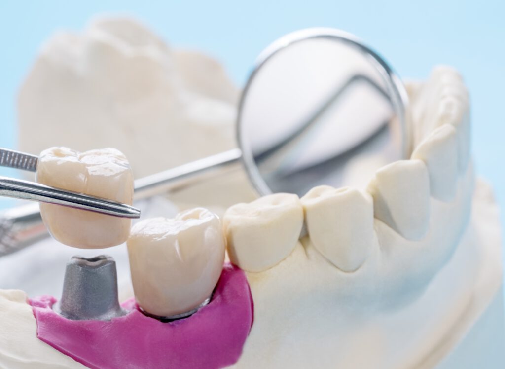 ¿Qué es un puente dental y para qué sirve? Like Dental