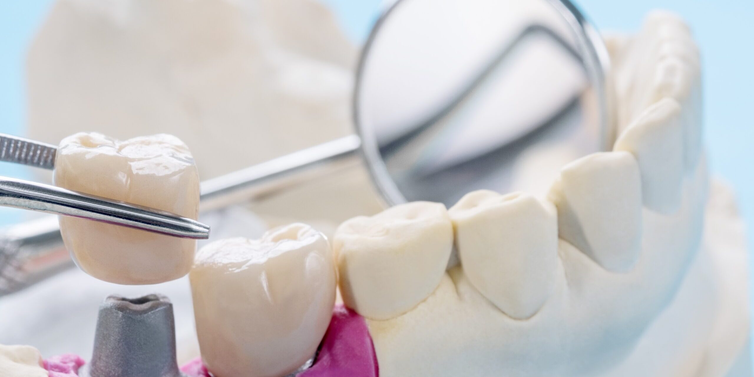 que es un puente dental – dientes que es un puente dental - dientes